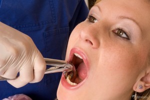Что делать после удаления зуба 