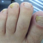 <b>Лечение грибка ногтей народными средствами</b>