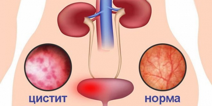 лечение цистита