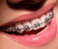 Исправление прикуса – эстетическая необходимость