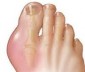 Воспаление косточки большого пальца ноги